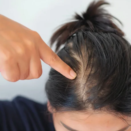 mulher-com-cabelos-ralos-mostrando-o-couro-cabeludo-orig-1 mulher-com-cabelos-ralos-mostrando-o-couro-cabeludo-orig-1